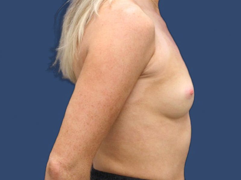 Breast Augmentation Before & After Gallery - Patient 114210533 - Image 3