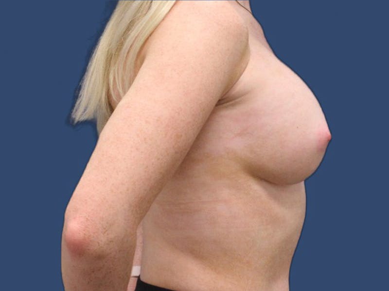 Breast Augmentation Before & After Gallery - Patient 114210533 - Image 4