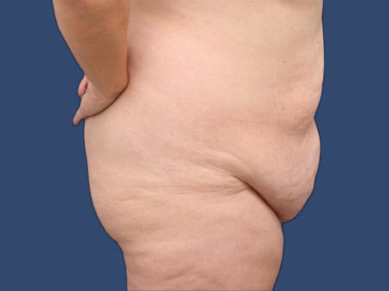 Tummy Tuck Before & After Gallery - Patient 114210535 - Image 3