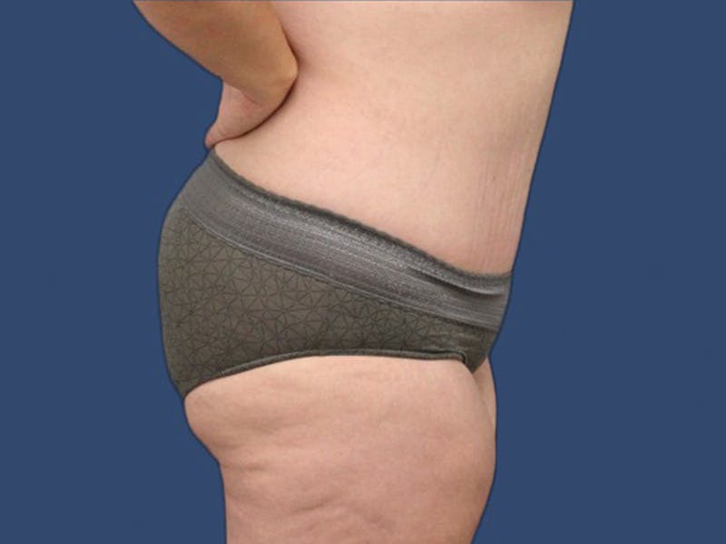 Tummy Tuck Before & After Gallery - Patient 114210535 - Image 4