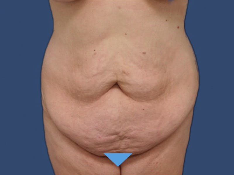 Tummy Tuck Before & After Gallery - Patient 114210535 - Image 1