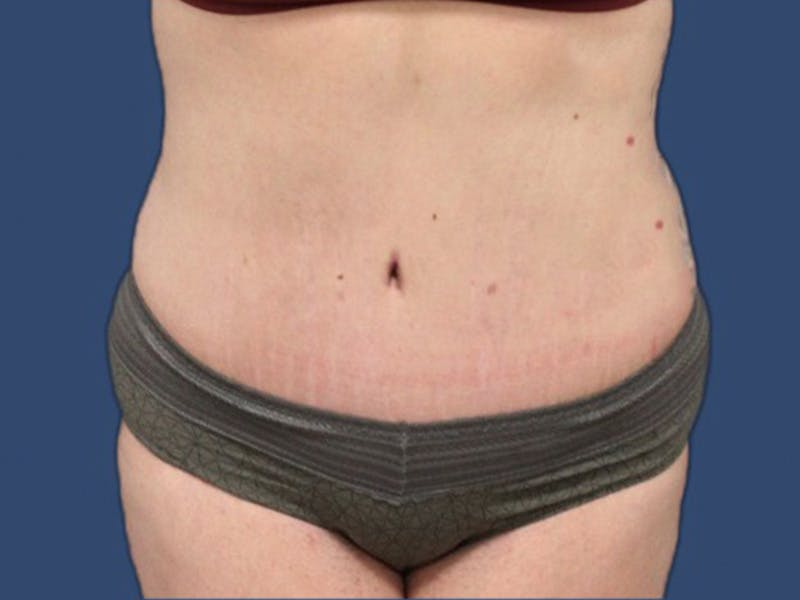Tummy Tuck Before & After Gallery - Patient 114210535 - Image 2
