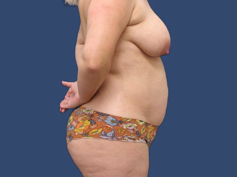 Tummy Tuck Before & After Gallery - Patient 131962961 - Image 3