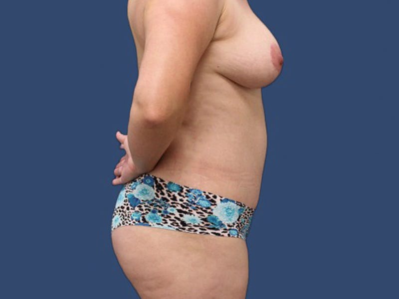 Tummy Tuck Before & After Gallery - Patient 131962961 - Image 4
