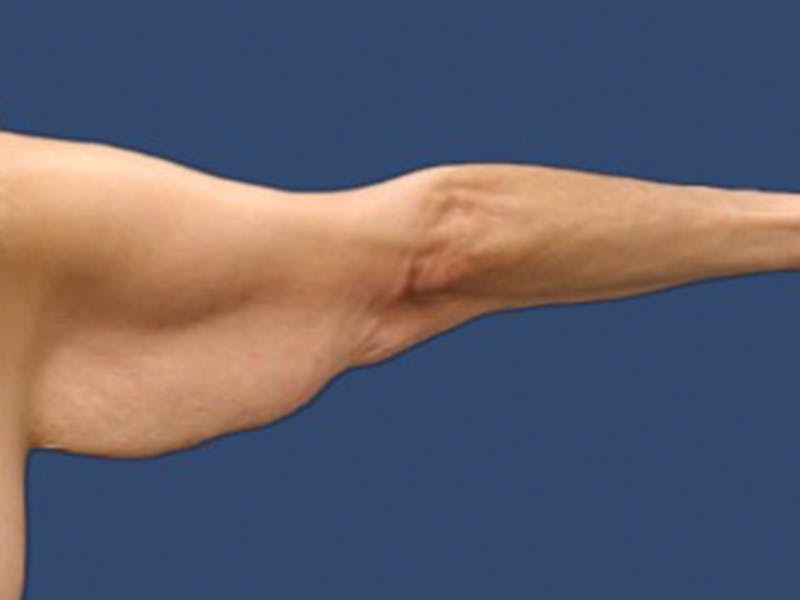 Arm Lift Before & After Gallery - Patient 132688088 - Image 1