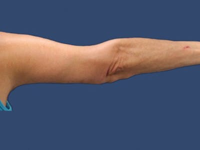 Arm Lift Before & After Gallery - Patient 132688088 - Image 2