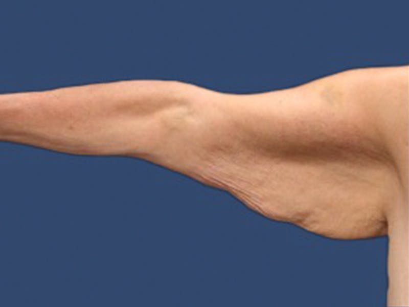 Arm Lift Before & After Gallery - Patient 132688088 - Image 3