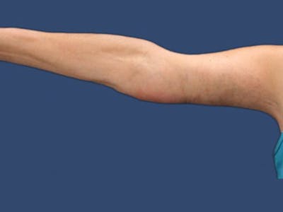 Arm Lift Before & After Gallery - Patient 132688088 - Image 2