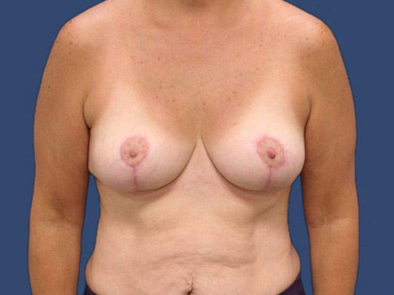 Breast Lift Before & After Gallery - Patient 186452508 - Image 2
