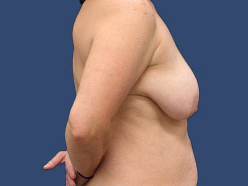 Breast Lift Before & After Gallery - Patient 186452508 - Image 3