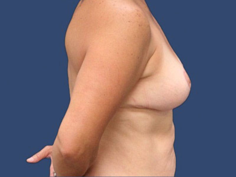 Breast Lift Before & After Gallery - Patient 186452508 - Image 4