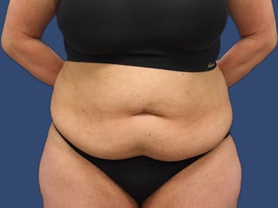 Tummy Tuck Before & After Gallery - Patient 186462332 - Image 1