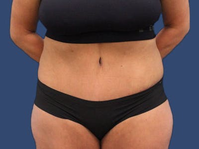 Tummy Tuck Before & After Gallery - Patient 186462332 - Image 2
