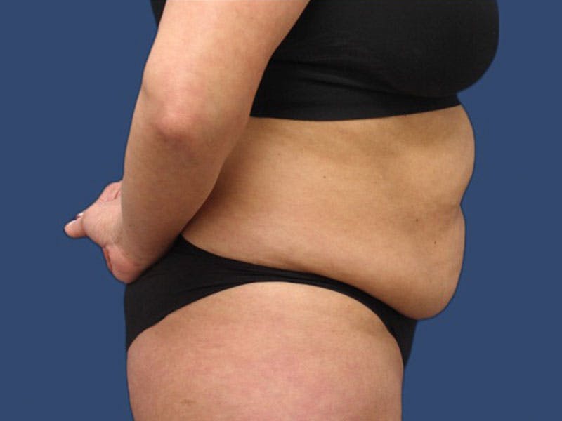 Tummy Tuck Before & After Gallery - Patient 186462332 - Image 3