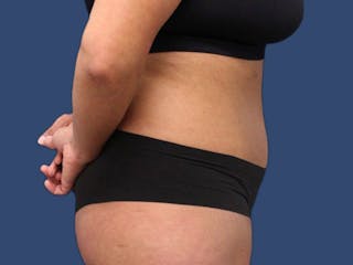 Tummy Tuck Before & After Gallery - Patient 186462332 - Image 4