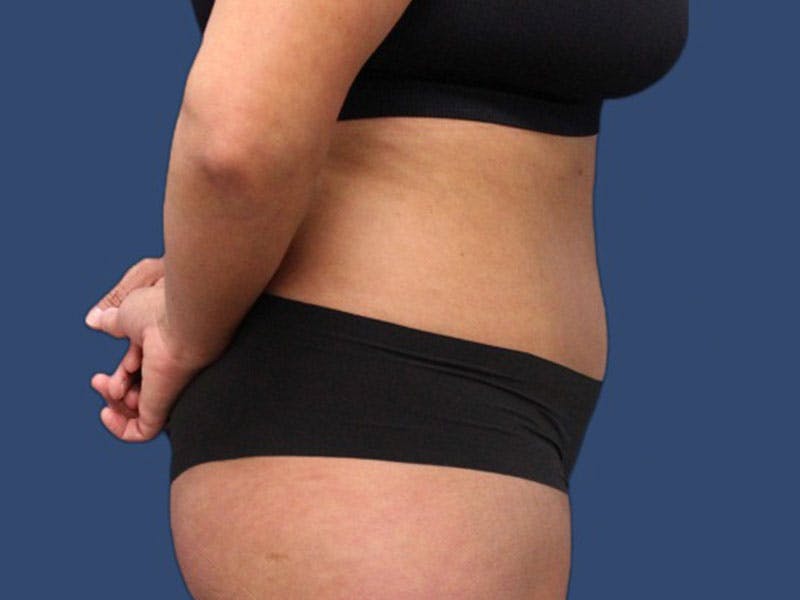 Tummy Tuck Before & After Gallery - Patient 186462332 - Image 4