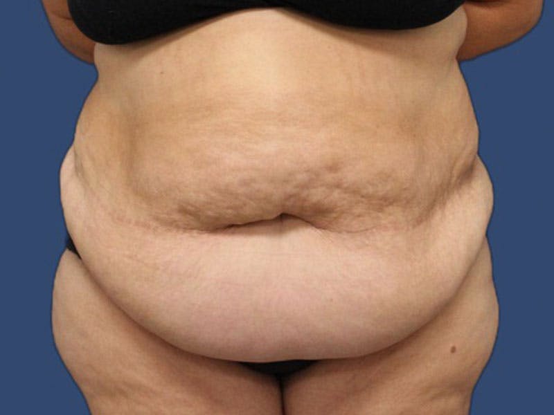 Tummy Tuck Before & After Gallery - Patient 186465158 - Image 1