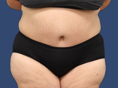 Tummy Tuck Before & After Gallery - Patient 186465158 - Image 2