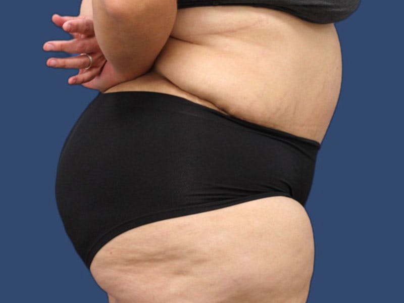 Tummy Tuck Before & After Gallery - Patient 186465158 - Image 4