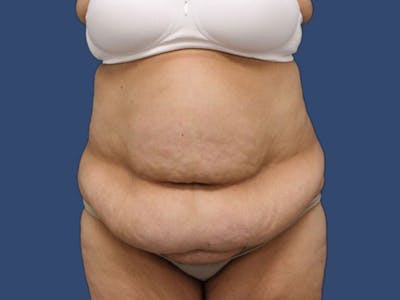 Tummy Tuck Before & After Gallery - Patient 186475017 - Image 1