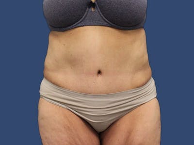 Tummy Tuck Before & After Gallery - Patient 186475017 - Image 2