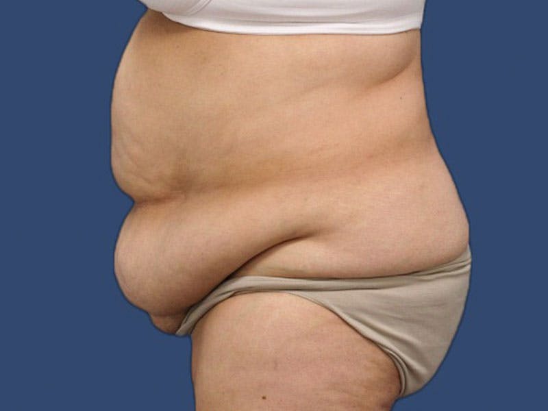 Tummy Tuck Before & After Gallery - Patient 186475017 - Image 3