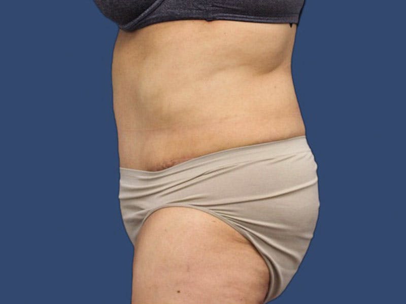 Tummy Tuck Before & After Gallery - Patient 186475017 - Image 4