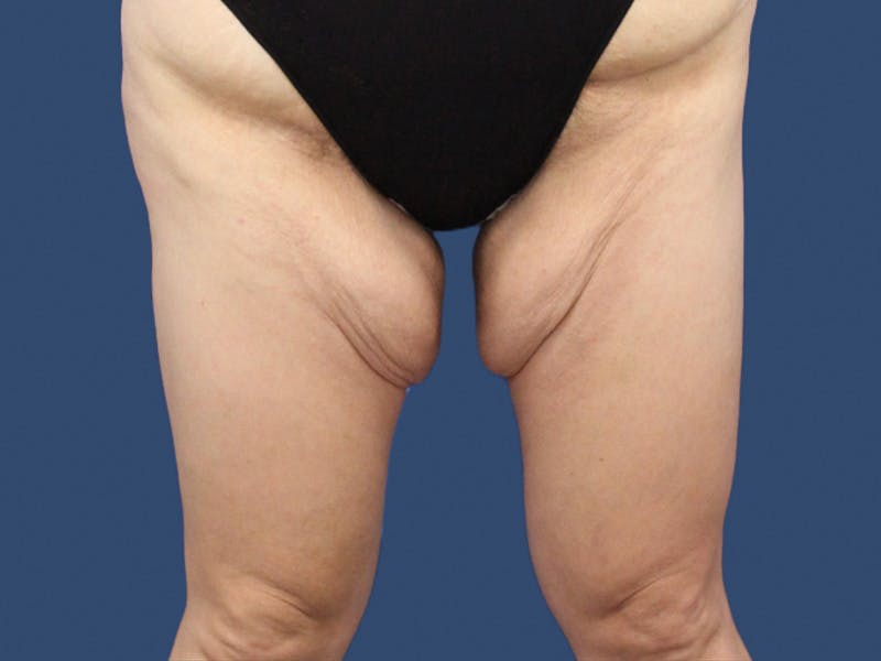 Thigh Lift Before & After Gallery - Patient 192665557 - Image 1