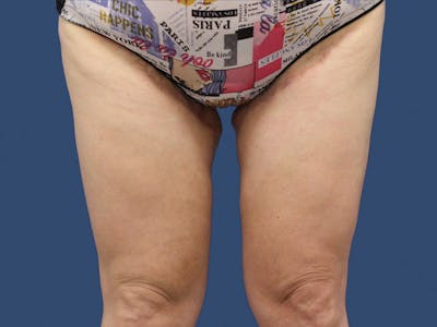 Thigh Lift Before & After Gallery - Patient 192665557 - Image 2