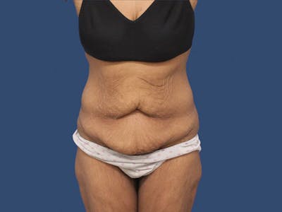 Tummy Tuck Before & After Gallery - Patient 192665653 - Image 1