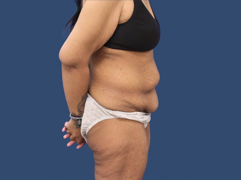 Tummy Tuck Before & After Gallery - Patient 192665653 - Image 3