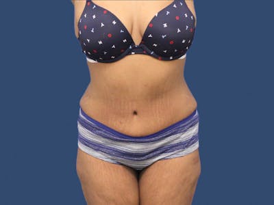 Tummy Tuck Before & After Gallery - Patient 192665653 - Image 2
