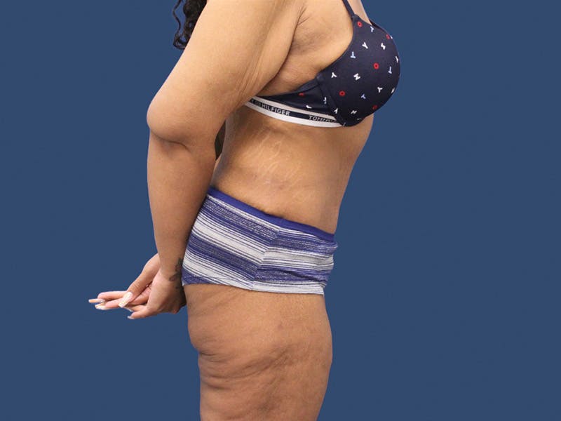 Tummy Tuck Before & After Gallery - Patient 192665653 - Image 4