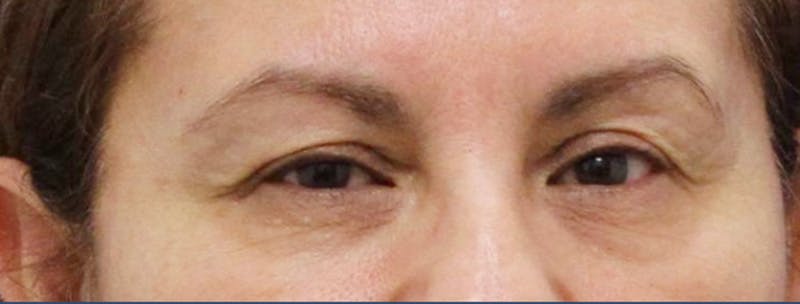 Eyelid Surgery Before & After Gallery - Patient 192665700 - Image 1