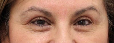 Eyelid Surgery Before & After Gallery - Patient 192665700 - Image 2