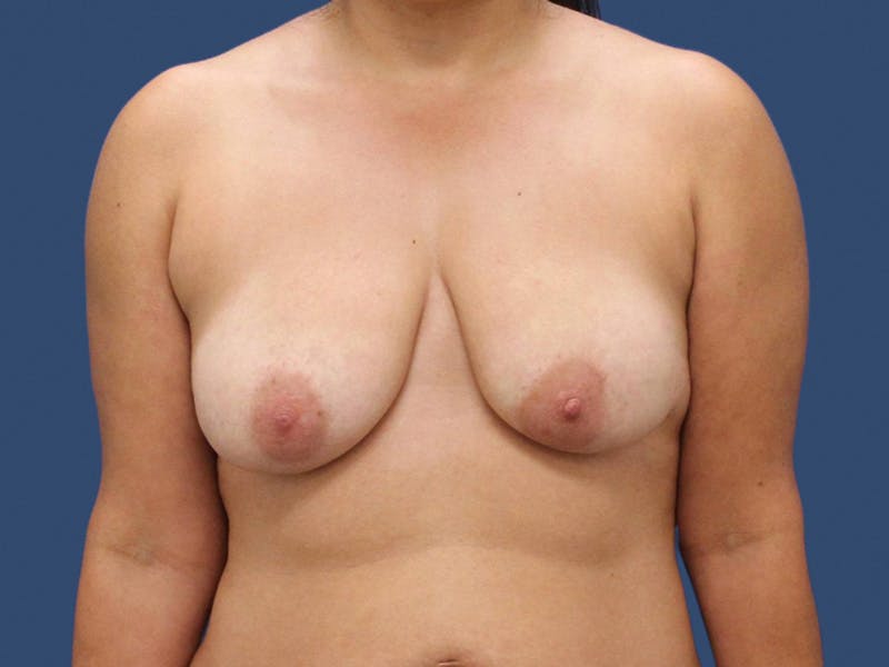 Breast Lift Before & After Gallery - Patient 195864903 - Image 1