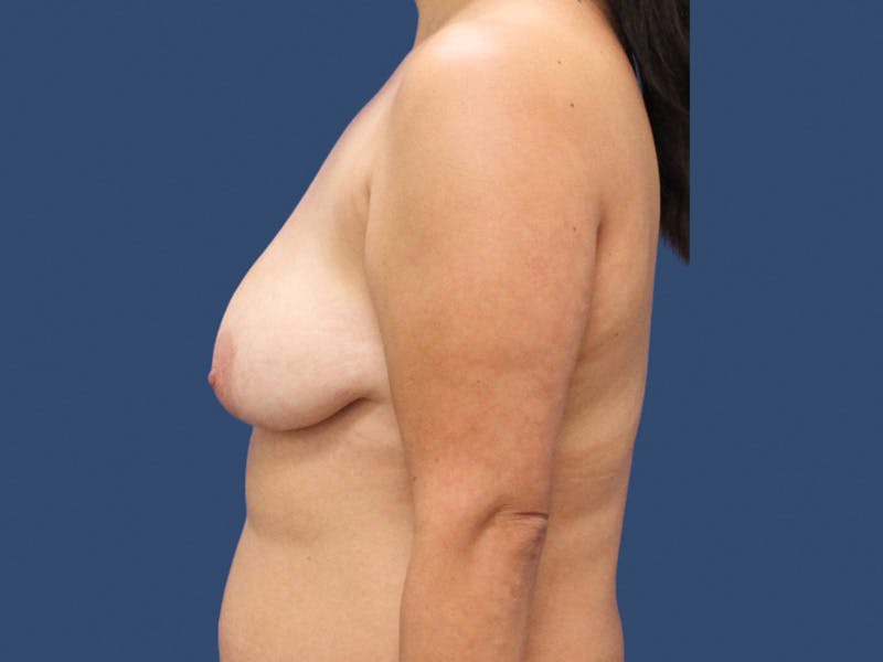 Breast Lift Before & After Gallery - Patient 195864903 - Image 3