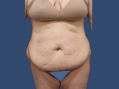 Tummy Tuck Before & After Gallery - Patient 195864977 - Image 1