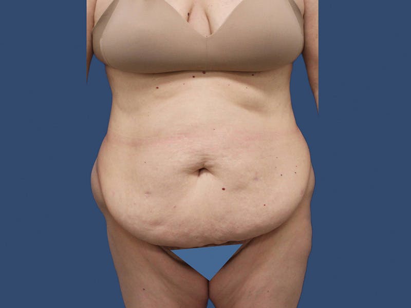 Tummy Tuck Before & After Gallery - Patient 195864977 - Image 1