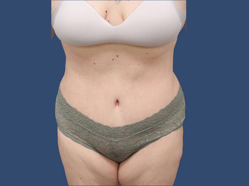 Tummy Tuck Before & After Gallery - Patient 195864977 - Image 2