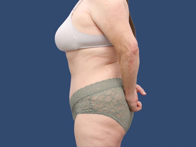 Tummy Tuck Before & After Gallery - Patient 195864977 - Image 4