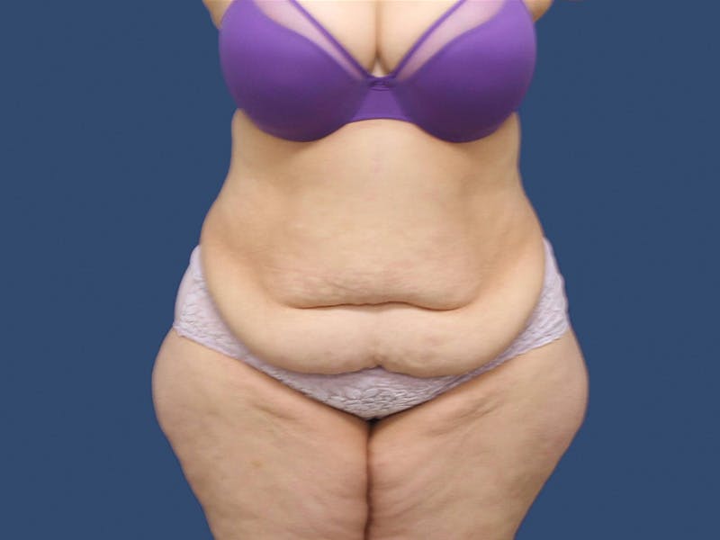 Tummy Tuck Before & After Gallery - Patient 195864988 - Image 1