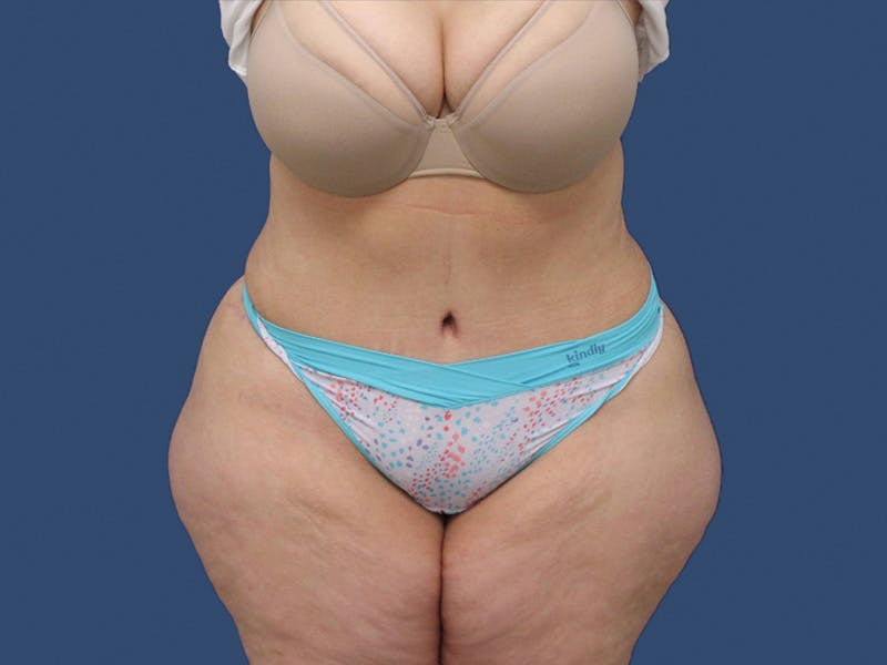 Tummy Tuck Before & After Gallery - Patient 195864988 - Image 2