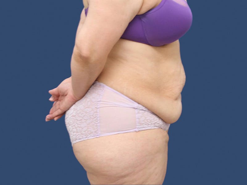 Tummy Tuck Before & After Gallery - Patient 195864988 - Image 3