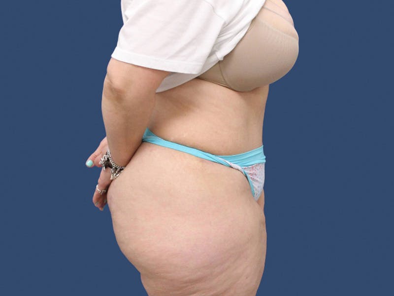 Tummy Tuck Before & After Gallery - Patient 195864988 - Image 4