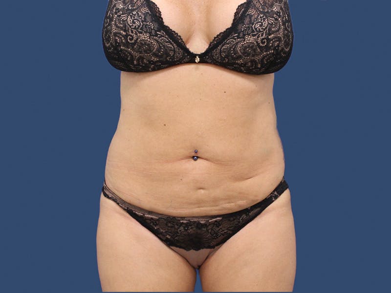 Tummy Tuck Before & After Gallery - Patient 192665740 - Image 1