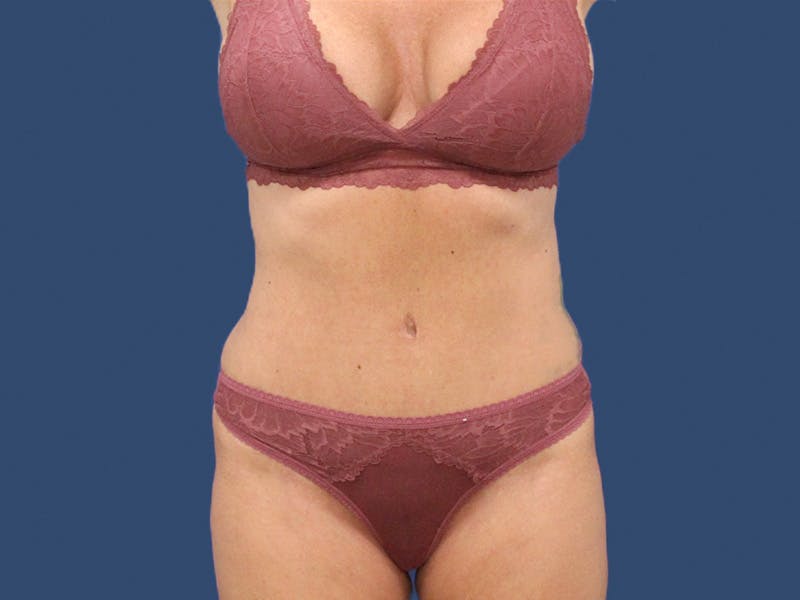 Tummy Tuck Before & After Gallery - Patient 192665740 - Image 2