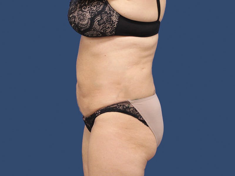 Tummy Tuck Before & After Gallery - Patient 192665740 - Image 3
