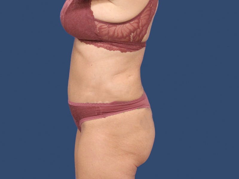 Tummy Tuck Before & After Gallery - Patient 192665740 - Image 4