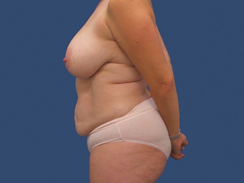 Mommy Makeover Before & After Gallery - Patient 309635 - Image 3